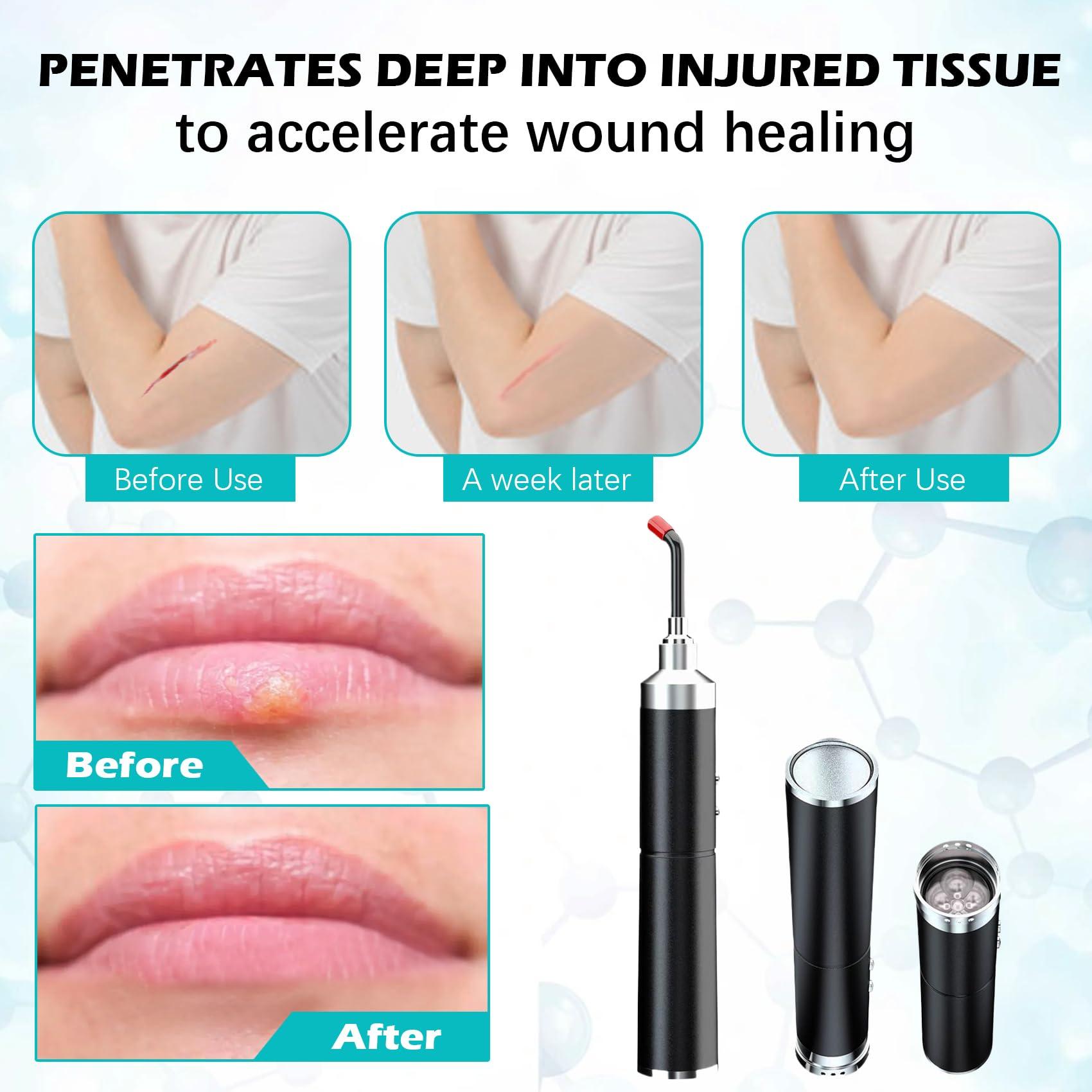 Red Light Therapy,Cold Sores Treatment&Fever Blister, Infrared Light Therapy for Lips Mouth Nose Ear Knee Feet Hands Joint Muscle Nerve Pain Relief Red Light Therapy for Face with Removable Tip - Image 2