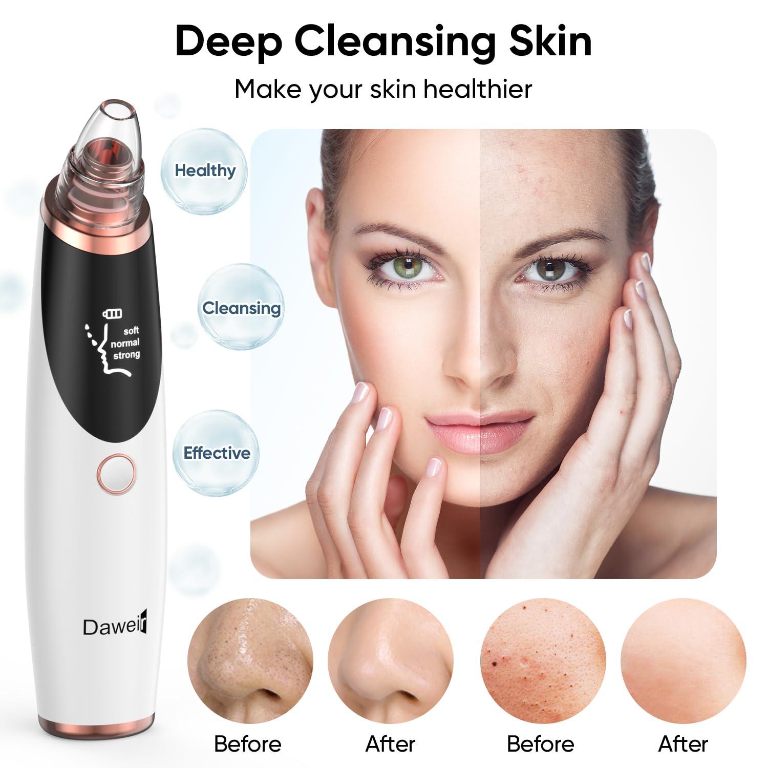 Daweir Blackhead Remover Pore Vacuum - Pimple Extractor Tools Pore Cleaner toolfor Face & Nose - Image 2