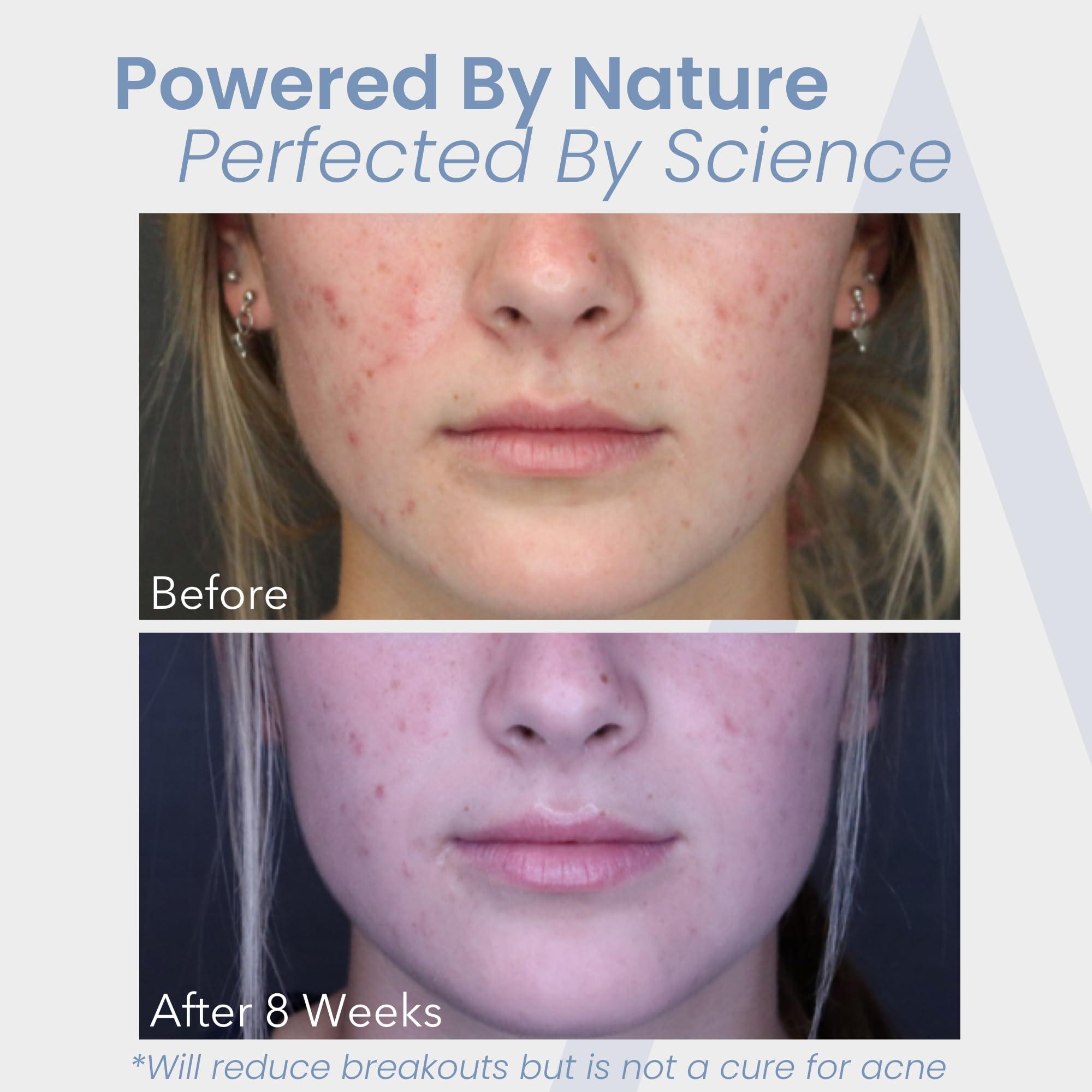 Hormonal Acne Treatment for Women - No DIM - (60 Capsules, 485 mg) – DIM-Free Acne Medication - Helps Nodular & Hormonal Acne - Best Acne Treatment for Teenagers & Adults - Image 5