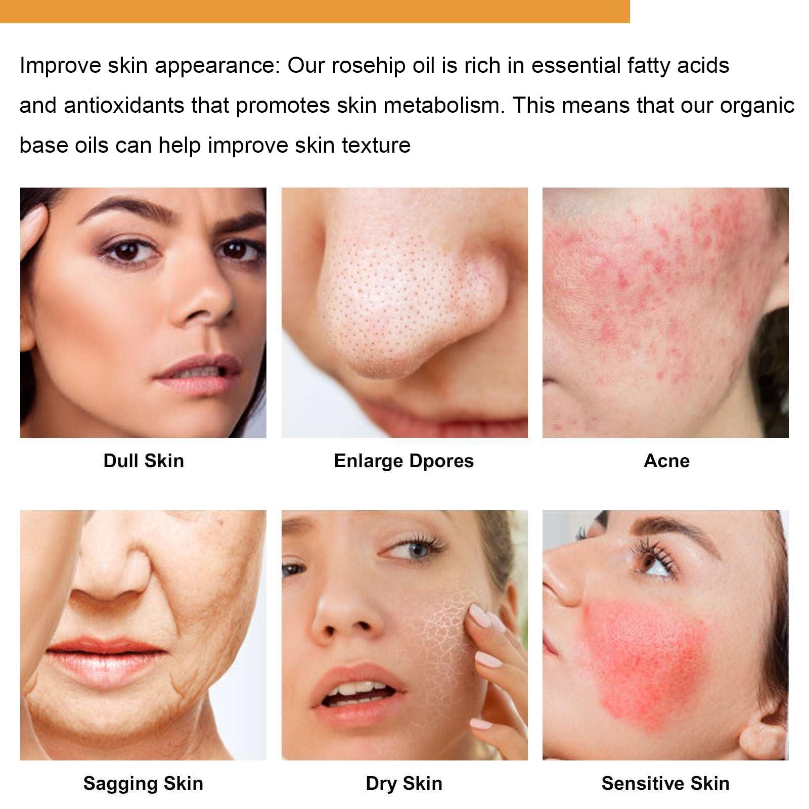 ARCHIDATE Rosehip Seed Oil for Face, 100% Organic Cold Pressed Rosehip Oil, Rose Hip Seed Oil Moisturizer Skin Face, Hair, Nails and Body, Anti-Aging, Smooth Fine Line & Wrinkle, 30ml - Image 2