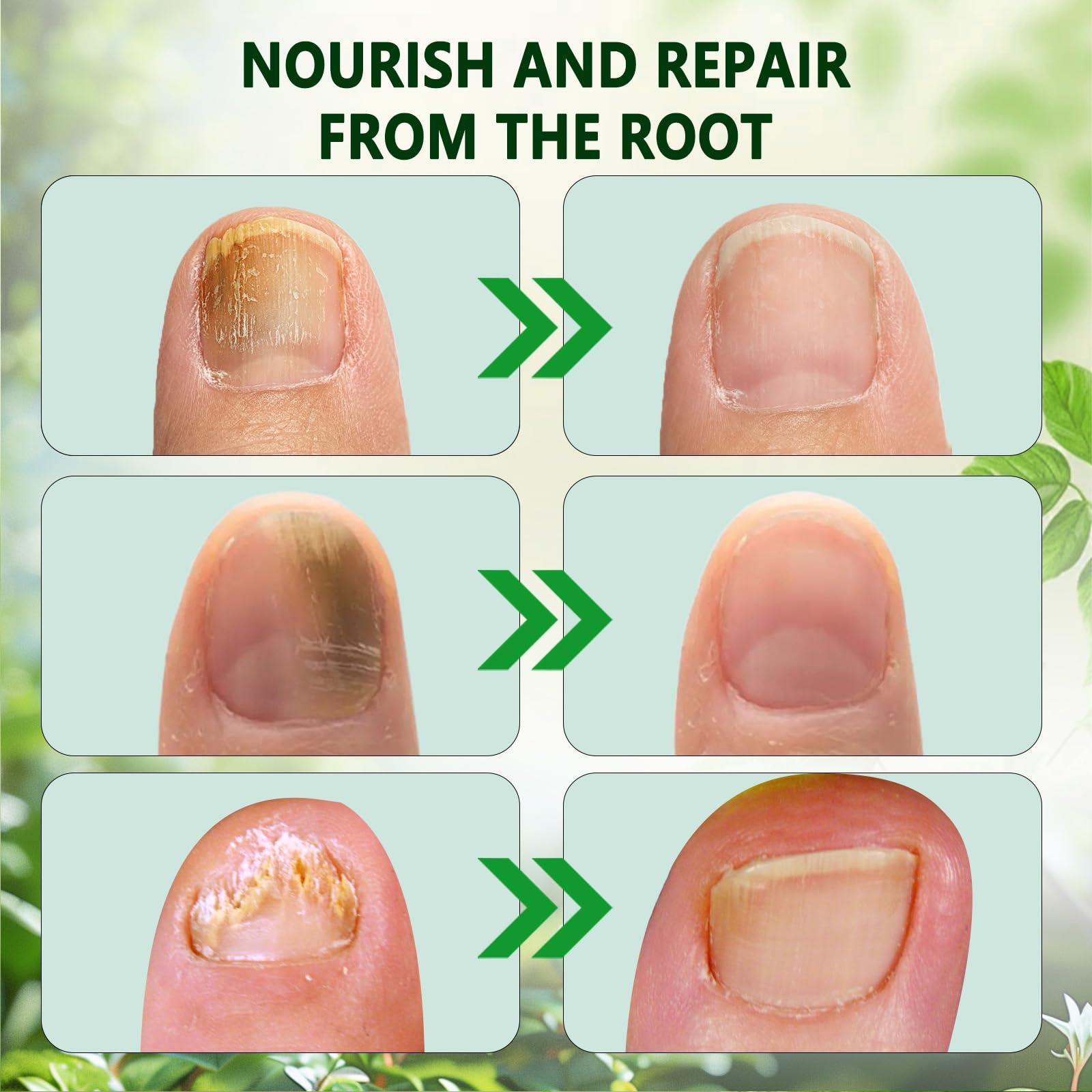 2PCS Ginger Nail Treatment – Nail Growth Serum & Cuticle Care Oil, 7-Day Nail Repair & Strengthener, Nourishing Nail Nutrient Oil for Healthier, Stronger Nails 2 Fl Oz (Pack of 2) - Image 2