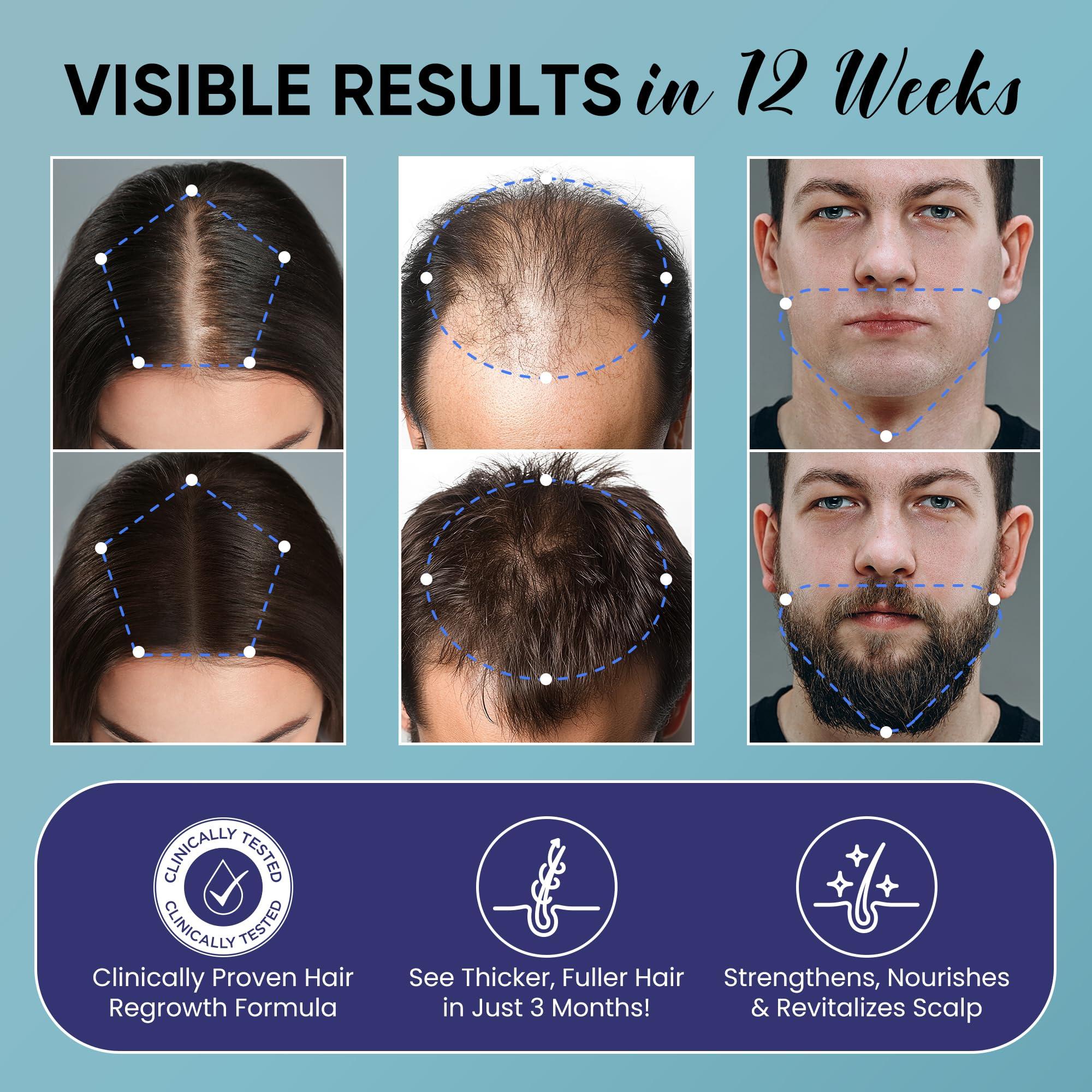 Minoxidil for Men and Women Hair Growth: 5% Minoxidil Spray Hair Regrowth Treatment Serum with Biotin & Rosemary -Stop Hair Thinning and Hair Loss For Stronger Thicker Longer Hair - 2 Pack - Image 3