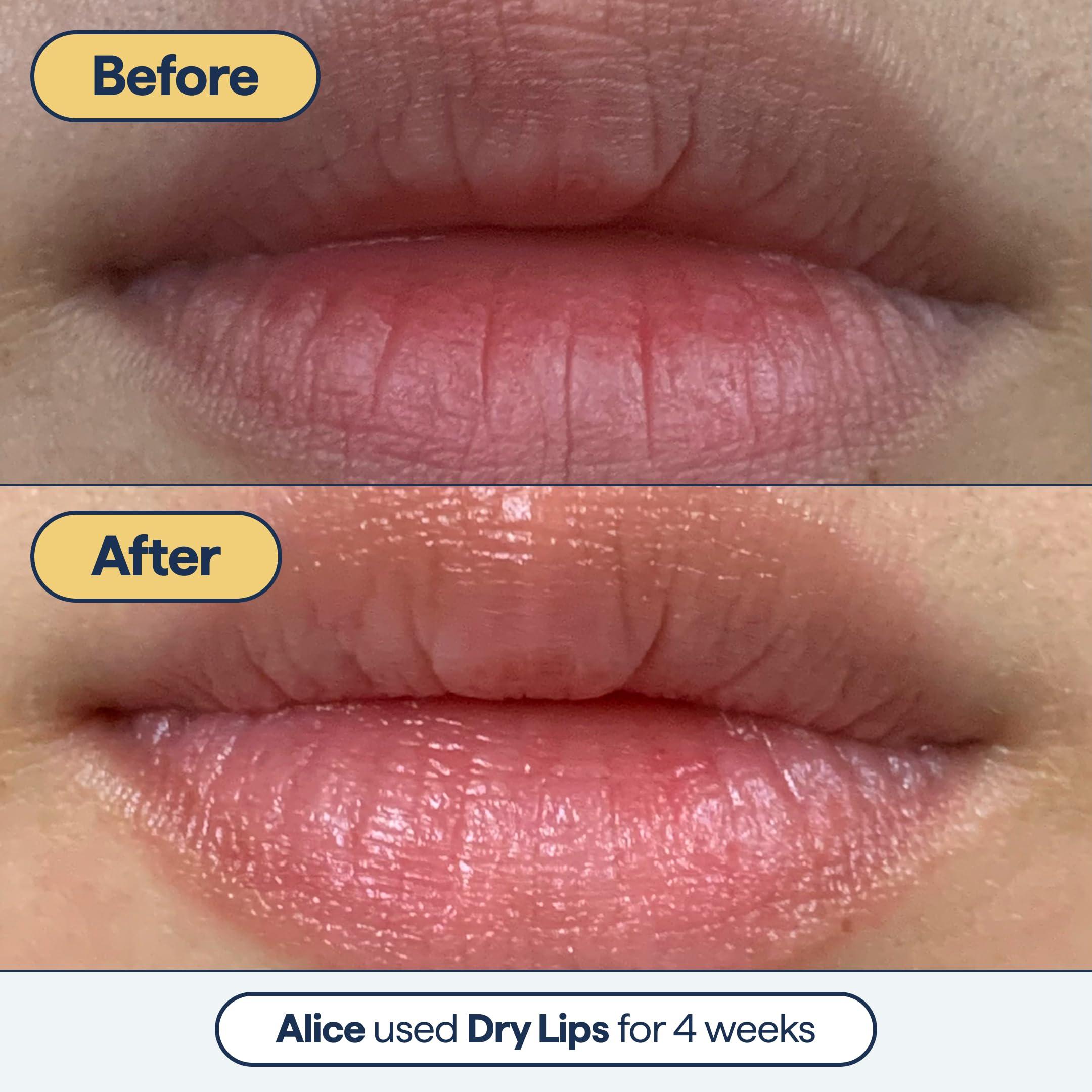 Remedy for Dry Lips - Hydrating and Healing Lip Balm Ointment with Ceramides, Peptides, and Dimethicone - Repairs Dry, Cracked Lips - By Dermatologist Dr. Shah - Image 5