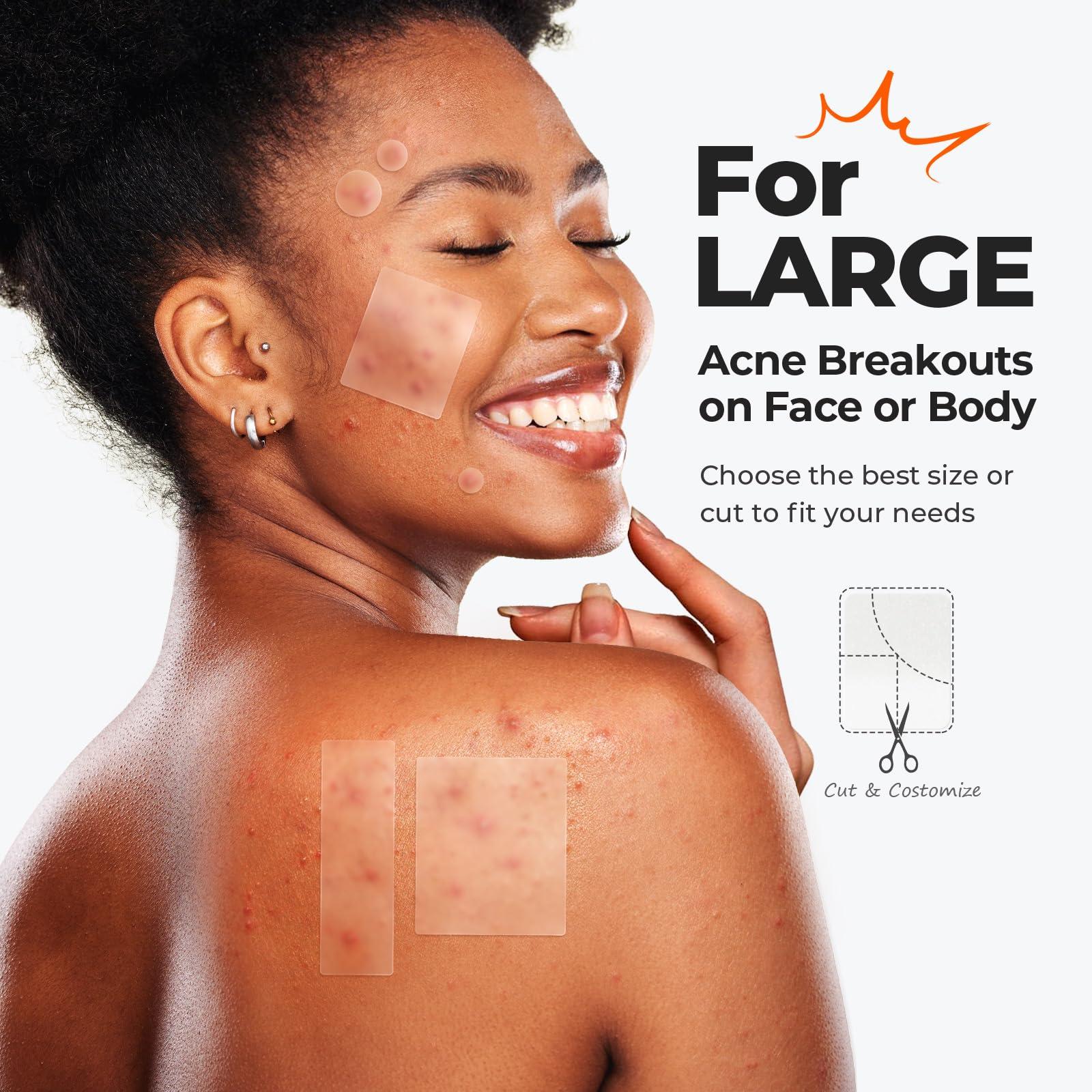 TKTK Large Pimple Patches (5 Sizes, 92 Patches), Hydrocolloid Acne Patches, XL Zit Patches for Face, Forehead, Chin, Nose, Body, Back, Chest, Rectangular, Square, and Dot Hydrocolloid Bandages - Image 3