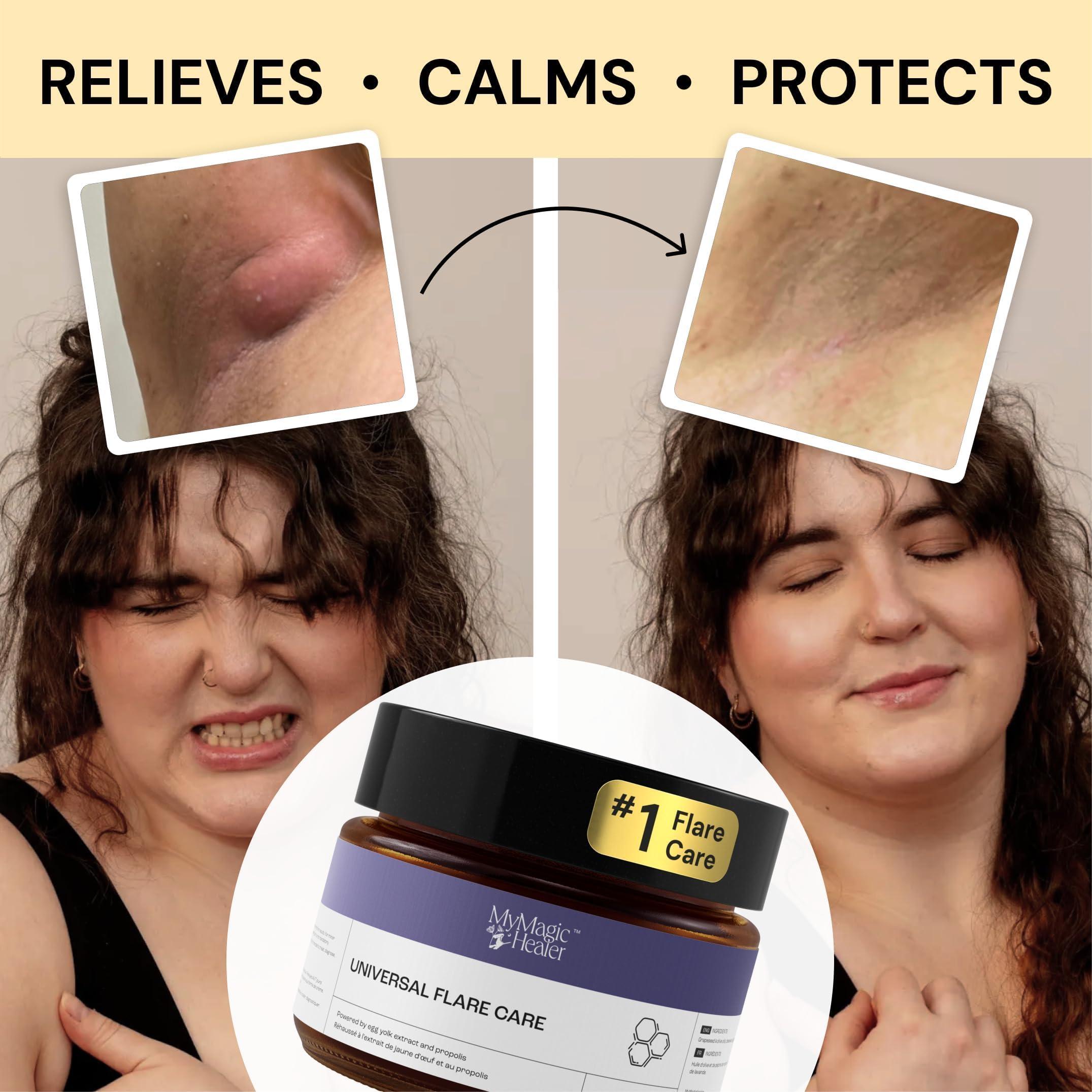 Universal Flare Care | Relief for 97% of Skin Issues | Cysts, Inflamed Skin, Hidradenitis Suppurativa, Abscesses, Impetigo | All Natural Flare Up Solution With Propolis & Egg Yolk Extract 1 oz - Image 3