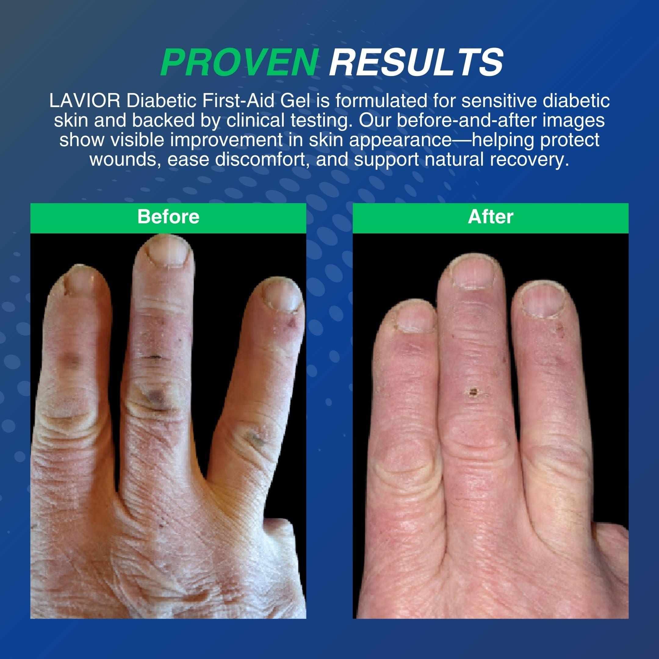 LAVIOR Diabetic First-Aid Gel 1oz – Speeds Healing for Cuts, Scrapes, Burns & Minor Injuries, Physician Recommended, Clinically Proven, Hypoallergenic, Infection Prevention & Pain Relief - Image 5
