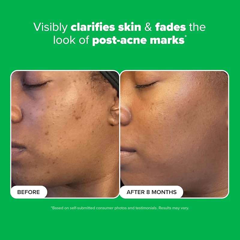 Paula's Choice BOOST 10% Azelaic Acid Booster Cream Gel Face Serum with Salicylic Acid, Minimizes Look of Redness & Fades Discoloration, Oil-Free Skin Brightening Serum for Face, Fragrance-Free - Image 4