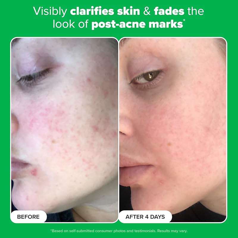 Paula's Choice BOOST 10% Azelaic Acid Booster Cream Gel Face Serum with Salicylic Acid, Minimizes Look of Redness & Fades Discoloration, Oil-Free Skin Brightening Serum for Face, Fragrance-Free - Image 5