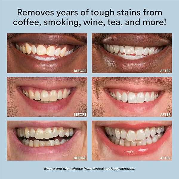 Auraglow Teeth Whitening Kit, LED Accelerator Light, 35% Carbamide Peroxide Teeth Whitening Gel, 20+ Whitening Treatments, Whitens up to 10 Shades in 7 Days - Image 6