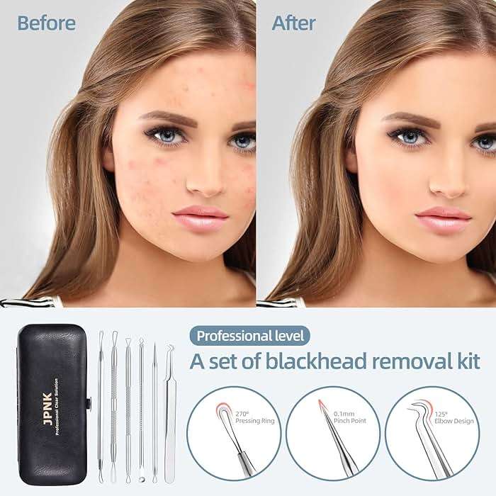 JPNK Blackhead Remover Comedone Extractor Acne Removal Kit.. | for Blemish, Whitehead Popping, 6 Pcs, Zit Removing, for Nose Face, Tools, with a Leather Bag - Image 2