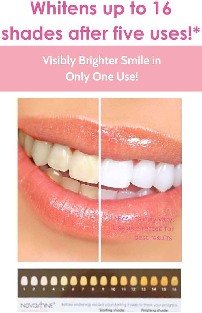 Novashine Professional Teeth Whitening Kit: Advanced Blue LED Light, Concentrated Peroxide Gel, Smartphone Adapter, Travel Bag - Image 2