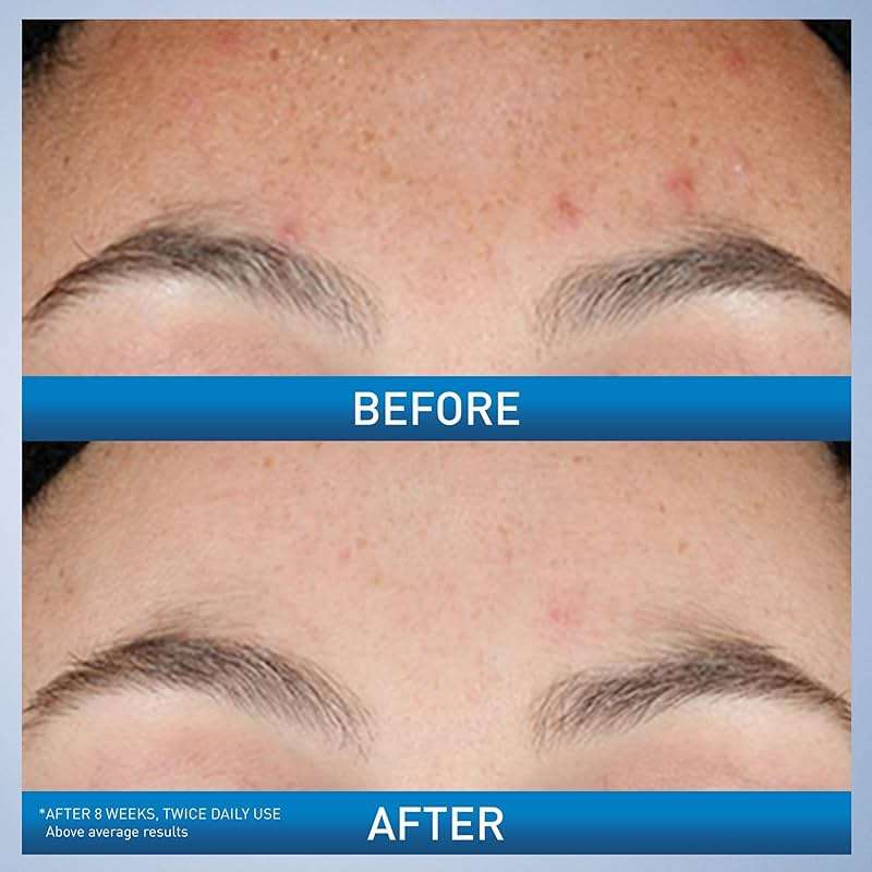 CeraVe Resurfacing Retinol Serum For Post Acne Marks, Formulated With Licorice Root Extract & Niacinamide, Brightening Serum & Pore Minimizer For Face, Post Acne Skin Barrier Repair, Non-Comedogenic - Image 3