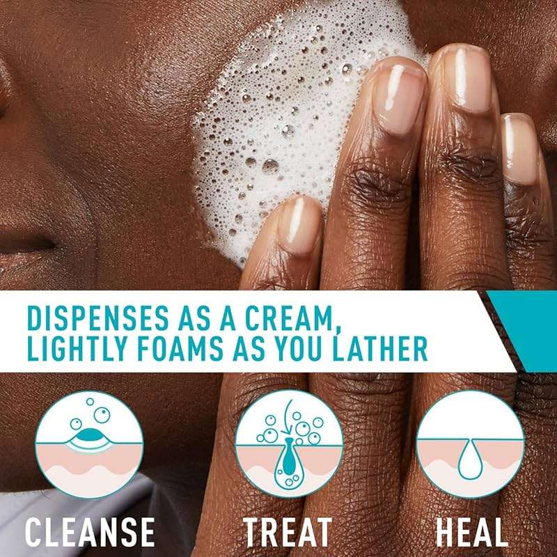 CeraVe Acne Foaming Cream Cleanser, 4% Benzoyl Peroxide Face Wash With Hyaluronic Acid, Niacinamide & Ceramides, Gentle Daily Acne Treatment For Face - Image 3