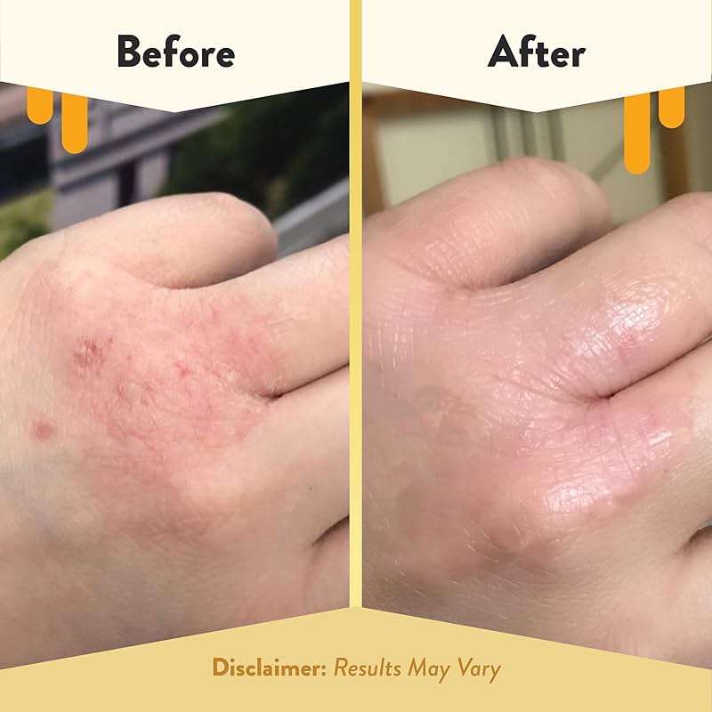ECZEMA HONEY Original Skin-Soothing Cream - Organic Hand & Body Eczema Relief - Natural Honey Lotion for Dry, Itchy, & Irritable Skin (4 Oz) - Image 4