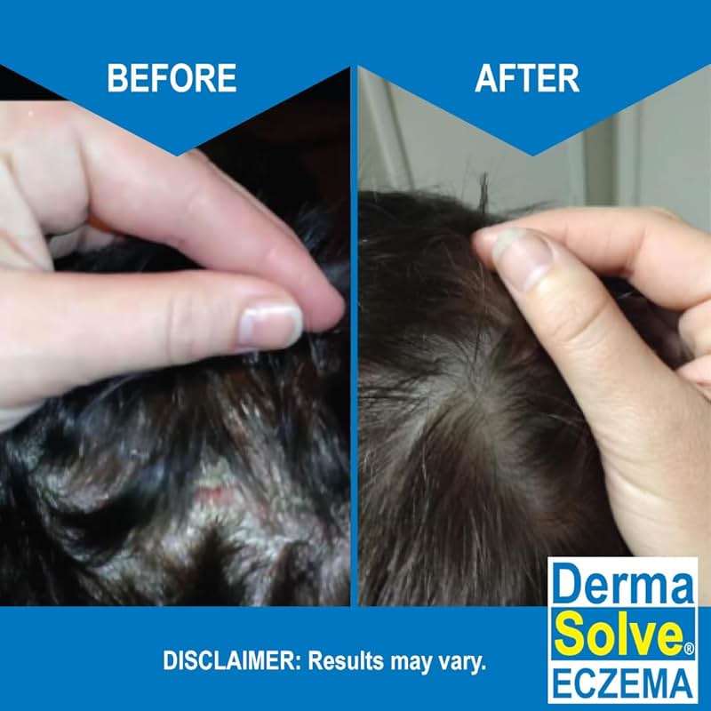 Eczema Shampoo & Conditioner (Combo Pack) - Flare Control Scalp & flake Relief Therapy that Protects, Moisturizes, and Repairs Skin by DermaSolve - Kids & Adults - Steroid Free - Image 3