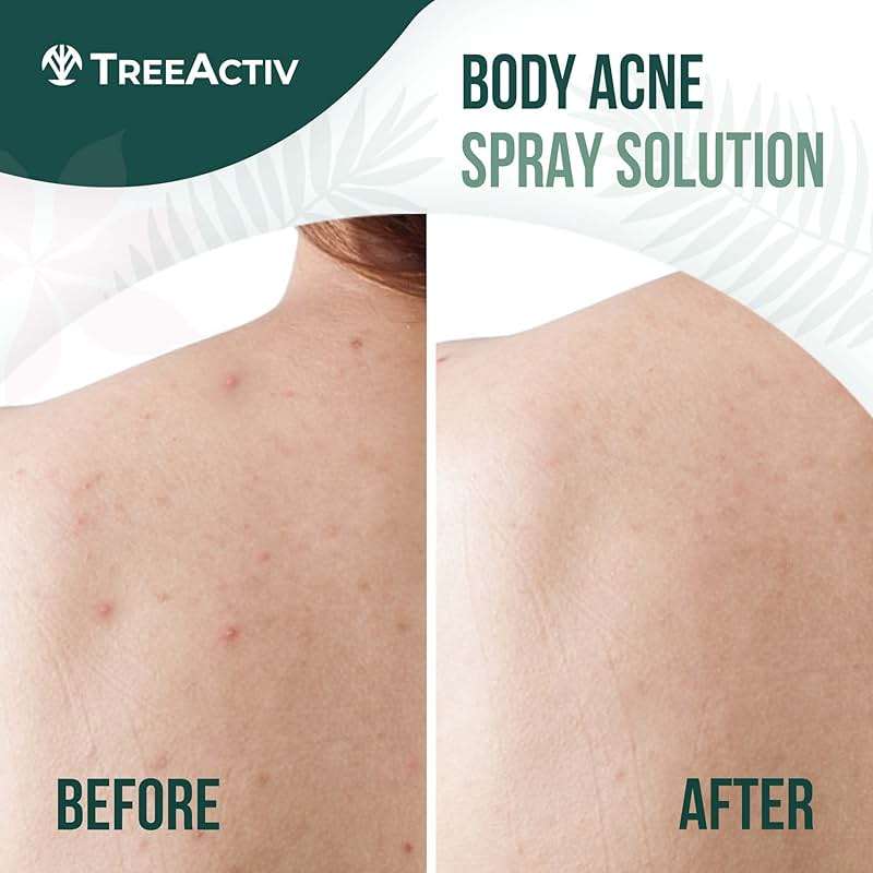 TreeActiv Salicylic Acid Back & Body Acne Spray, Fine Mist Back Spray for Bacne & Chest Acne, Tea Tree + Eucalyptus, Fast-Drying Non-Staining, 4 fl oz (2-Pack, 8 fl oz Total) - Image 2