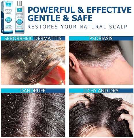 Roycederm Seborrheic Dermatitis & Psoriasis Shampoo for Dandruff - Helps Relieve Itching, Flaking & Scaling, Dry Itchy Scalp - Image 5