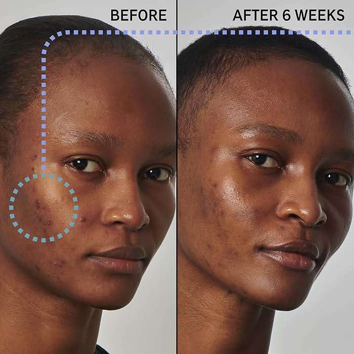 The INKEY List SuperSolutions Niacinamide 20% Serum, Helps with Healthy-Looking Skin Texture, Pores and Balancing Excess Oil, Skin Barrier Protection 1.01 fl oz - Image 2