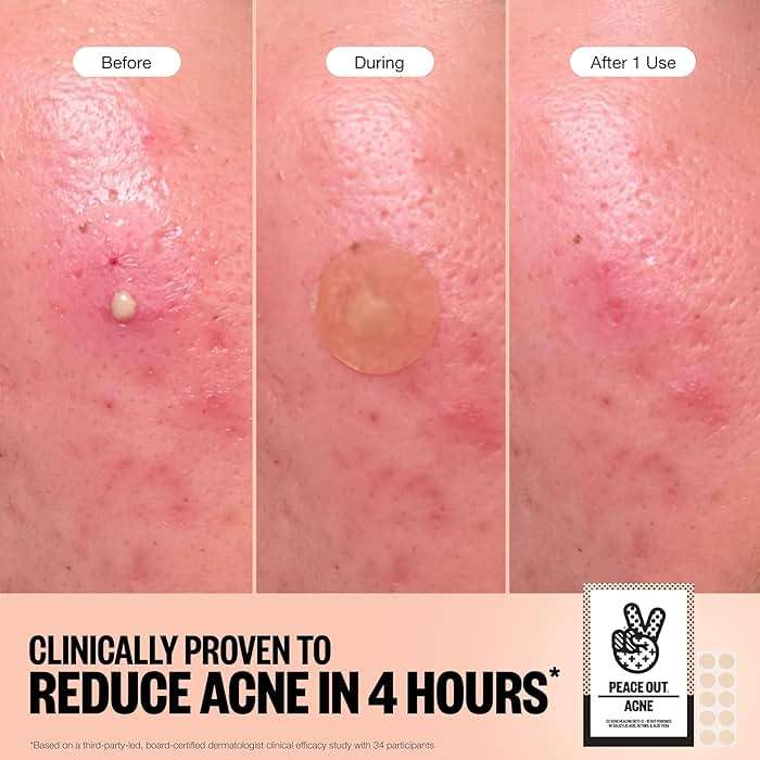 PEACE OUT Acne Healing Dots Hydrocolloid Pimple Patches, Acne Spot Treatment with Salicylic Acid, Retinol, and Aloe Vera for Blemishes and Breakouts (40 count) - Image 3