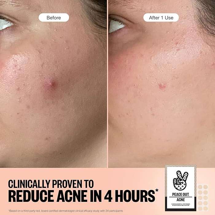 PEACE OUT Acne Healing Dots Hydrocolloid Pimple Patches, Acne Spot Treatment with Salicylic Acid, Retinol, and Aloe Vera for Blemishes and Breakouts (40 count) - Image 7