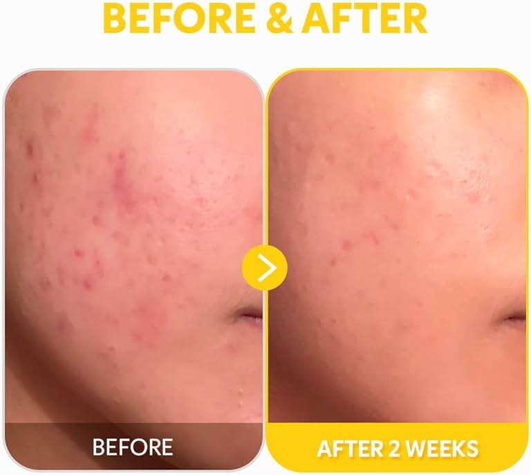TIRTIR Pure Vitamin C 24% Face Serum – Dark Spot Remover for Sensitive Skin with Collagen Anti Aging Even out Skin Tone Non irritation tested, Wrkinkles, Korean Mild Vita C Facial Serum 1.01 Fl Oz - Image 8