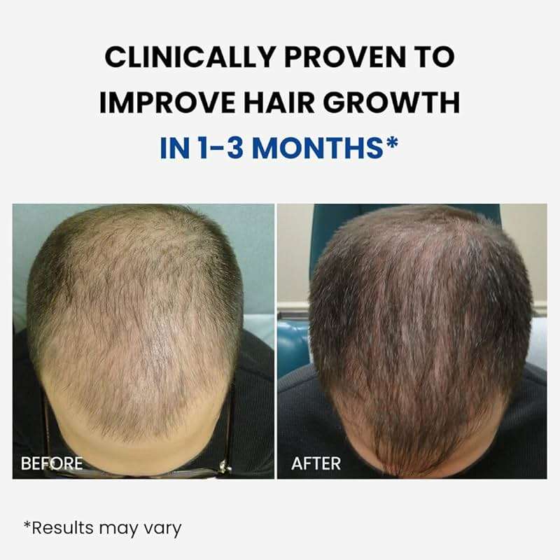 ForHair- Men Hair Growth Spray – Stimulates New Hair, Strengthens Follicles – Local Regrowth Action, No Unwanted Body Hair – Safe and Easy Alternative to Pills,Costly and Painful Treatments - Image 2