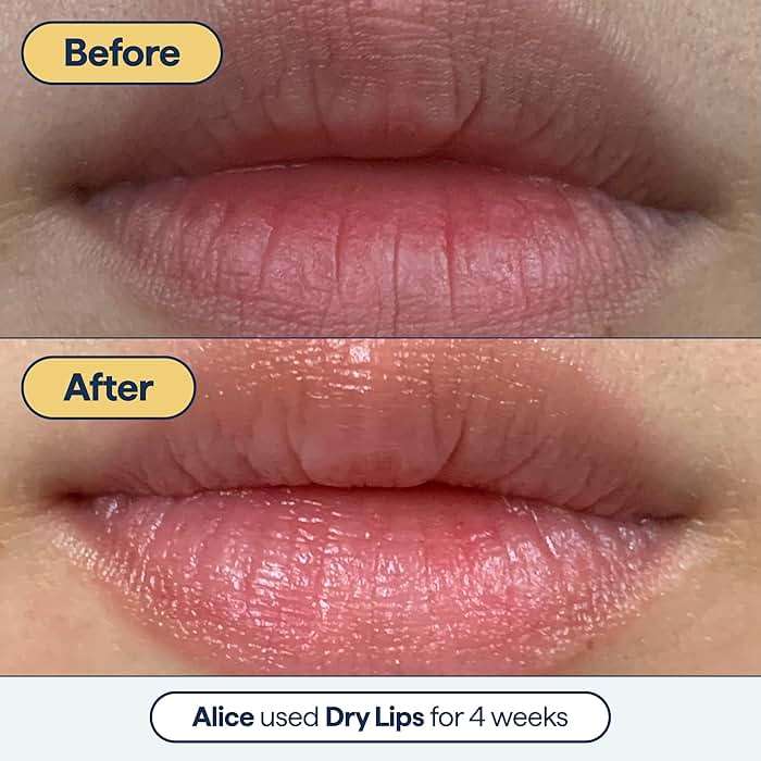 Remedy for Dry Lips | All-In-One Lip Treatment | Hydrating and Healing Lip Balm Ointment with Ceramides, Peptides, and Dimethicone | Repairs Dry, Cracked Lips | By Dermatologist Dr. Shah - Image 5
