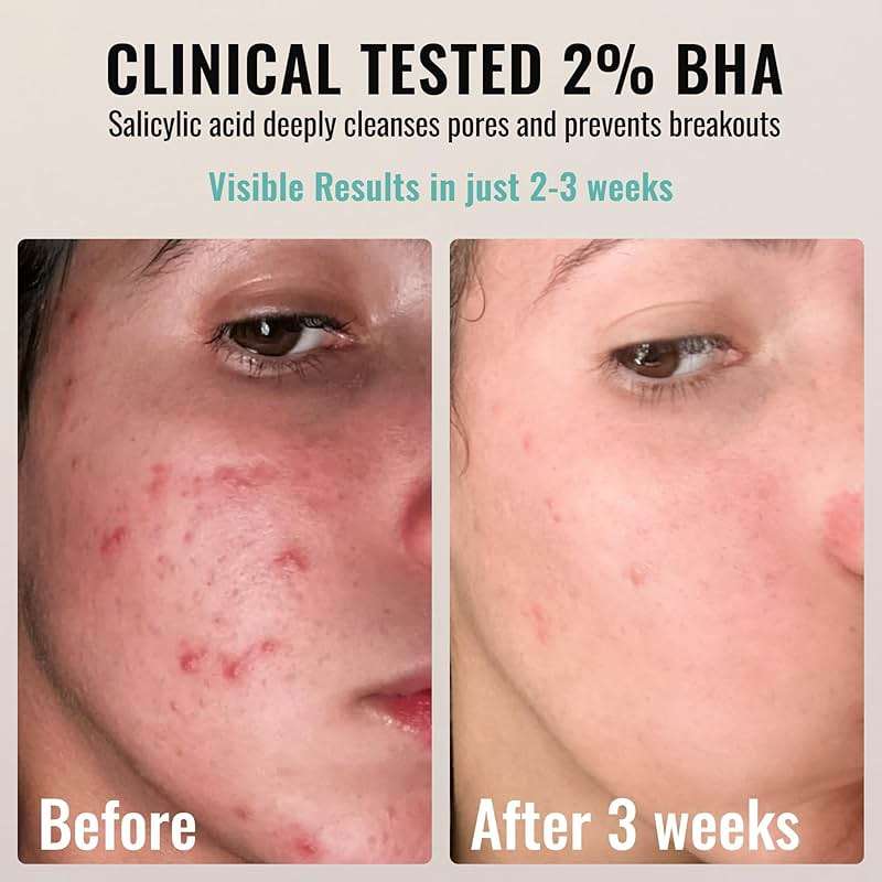 ADM 2% BHA AHA Liquid Exfoliant - Salicylic Acid Serum - Pore Minimizer, Gentle Peel for Blackheads & Wrinkles with Hyaluronic Acid, Fragrance-Free, Hydrating for All Skin Types, 2oz - Image 6