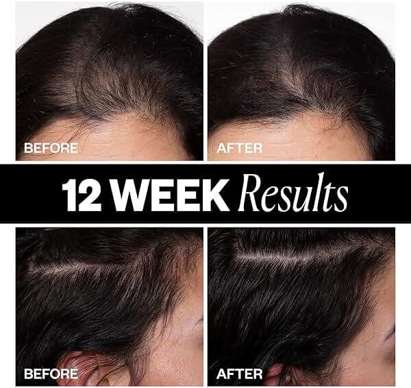 IGK SPONSORED Scalp Treatment for Hair Growth | Thickening Serum for Thinning Hair | Clinically Tested Mist for Hair Density and Volume | 2.1 Oz - Image 4