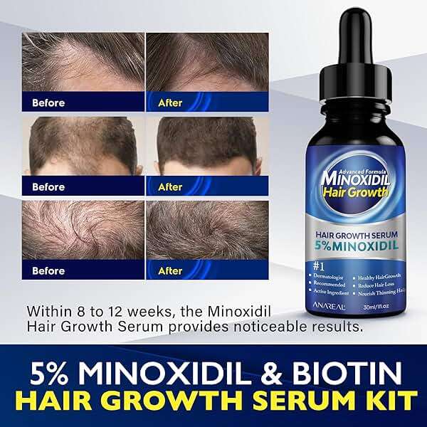 ANAREAL Minoxidil for Men and Women, 5% Minoxidil for Men Beard Growth enriched with Biotin, Minoxidil for Women Hair Growth, Minoxidil Beard Growth Oil, Beard Growth Serum - Image 2