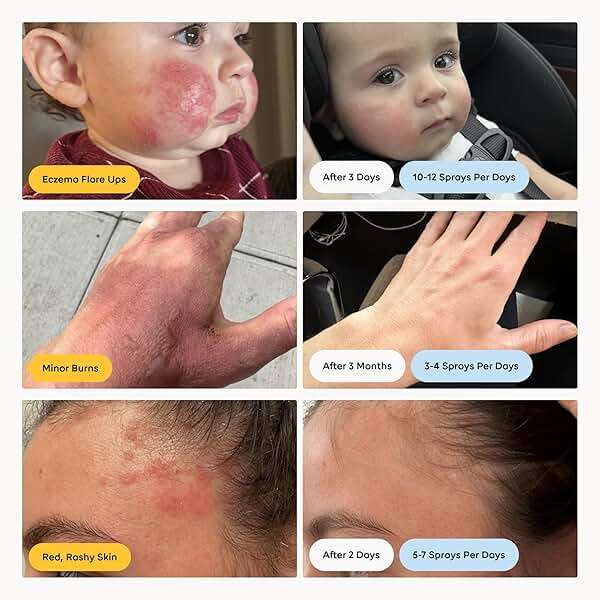 Magic Molecule Skin Cleanser for All Types, Hypochlorous Acid Spray Helps Heal Acne Prone, Eczema and Itchy Rashes and 50 Other Skin Ailments, 8 oz Spray (Pack of 3) - Image 5