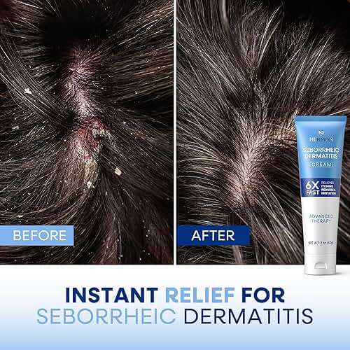 Hermon Seborrheic Dermatitis Scalp Treatment Cream: Soothing Itching Redness Scaling of Seborrheic Dermatitis - Fast-Acting Anti-Itch Ointment for Scalp Face Chest and Body for Men and Women 1 Pack - Image 4