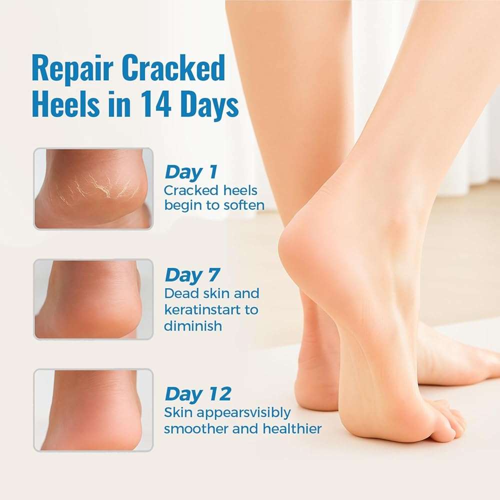 HOMEDSUN 2 Pairs Moisturizing Gel Toeless Socks for Dry Feet Cracked Heel Stick Repair Treatment Women Hydrating Foot Spa Moisture Softens Reusable Pedicure Sock - Image 2