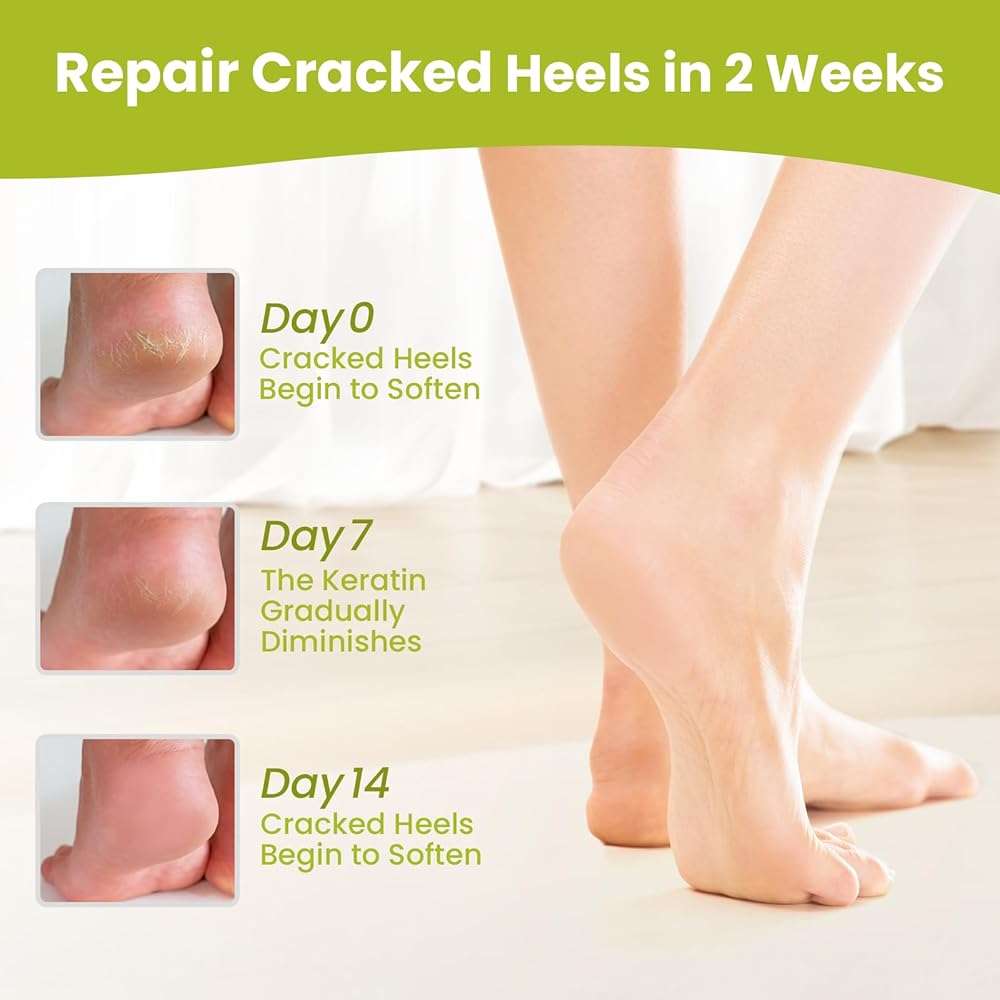 Moisturizing Socks for Cracked Heel Treatment - Bukihome 2 Pairs Moisturizer Socks for Dry Cracked Feet - Toeless Gel Socks for Women & Men,Hydration and Repair (Green) - Image 4