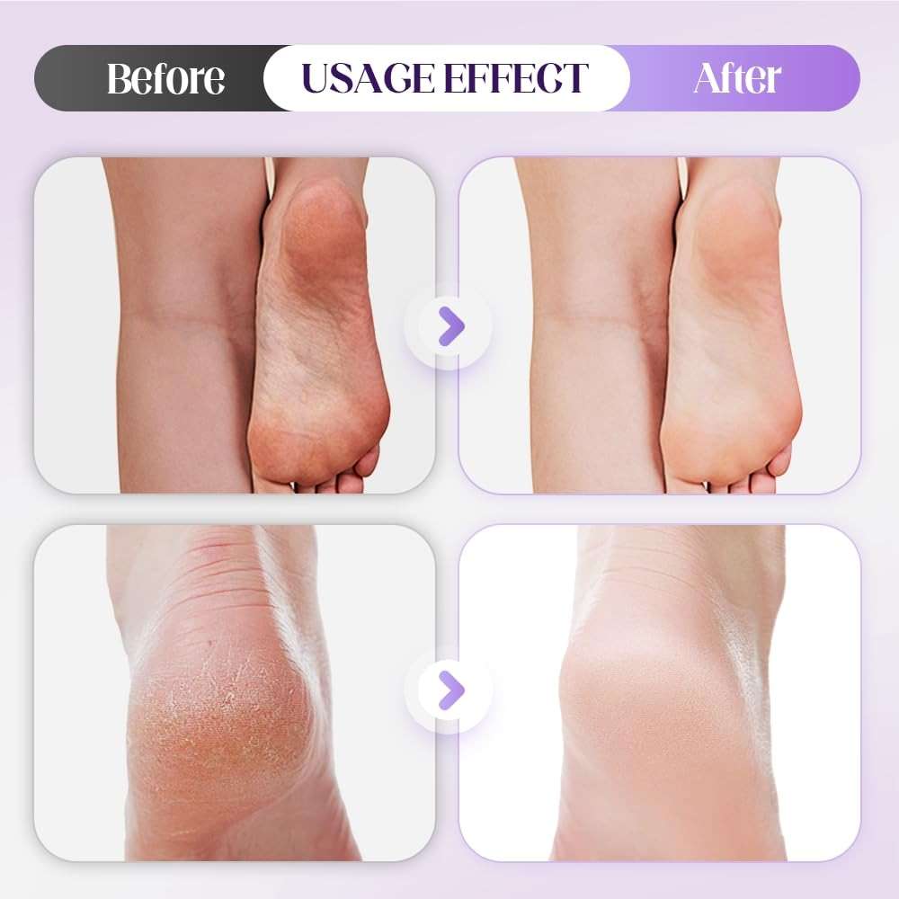 Foot Pumice Stone with Stripes to Increase Friction, 2025 Upgraded Professional Pedicure Foot Pumice Stone for Feet Hard Skin Callus Remover and Scrubber, Durable Exfoliating Stone for Spa Pedicure - Image 5