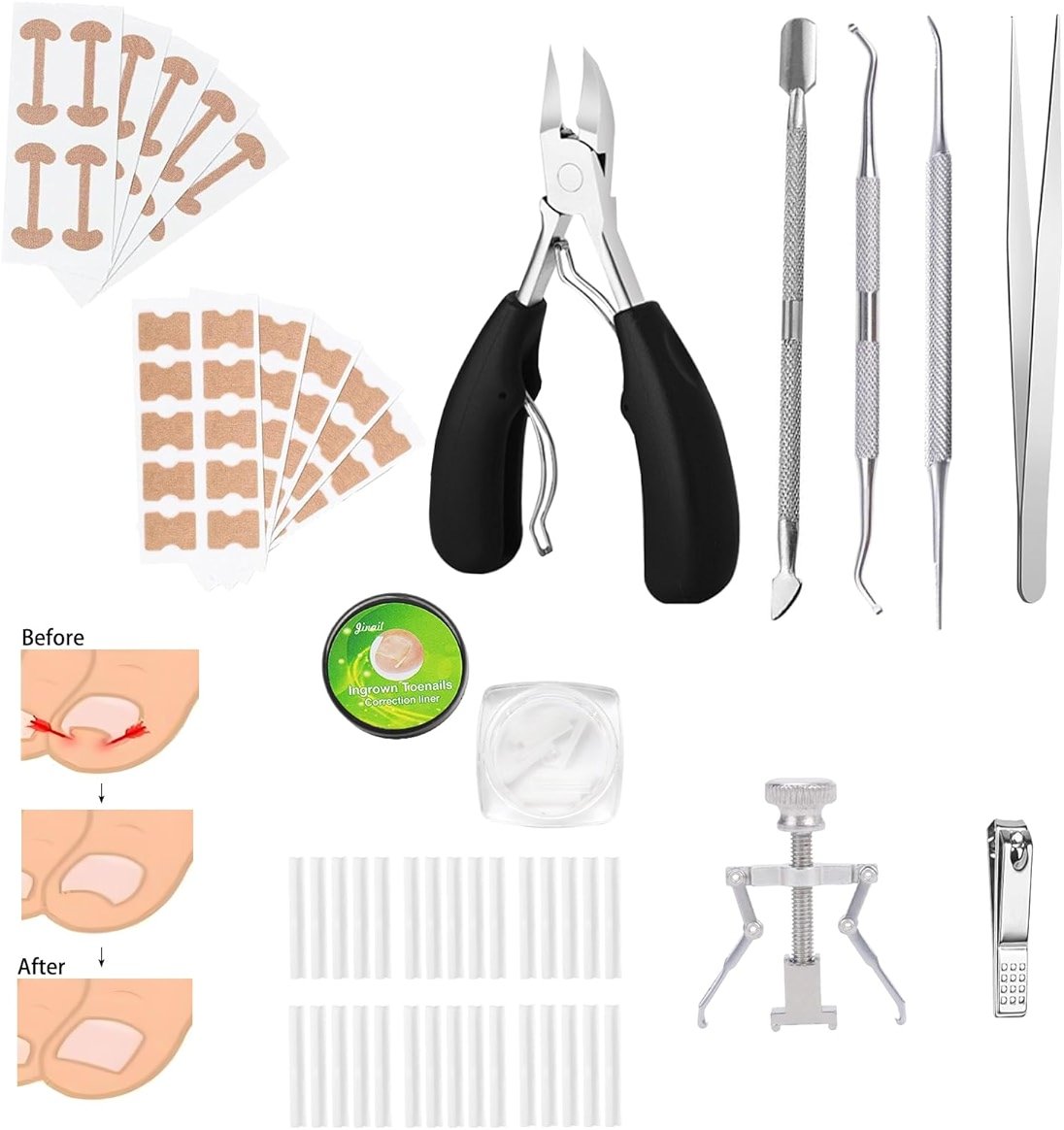 Ingrown Toenail Corrector Set, Professional Foot Care Kit for Ingrown Toenail Treatment & Removal, Toenail Straightener for Curved Pincer Thick Nails, Home Pedicure Tools for Men Women - Product Image