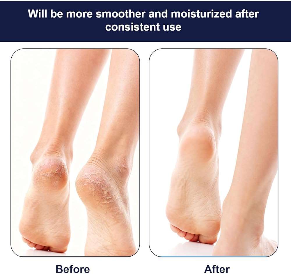 3 Pairs Moisturizing Heel Socks Dry Cracked Feet, Toeless Gel Socks, Heel Sock for Spa, Foot Care, Overnight Repair Treatment for Women & Men(Black, Grey, Navy Blue) - Image 6